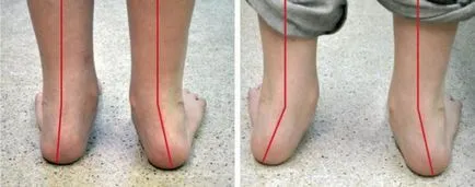 Valgus крак деформация при деца снимка, лечение, причини, симптоми (валгус) Valgus крак деформация в детски фото, лечение, причини, симптоми