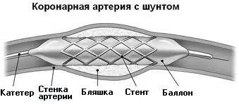 Видове хирургично лечение на инфаркт на миокарда