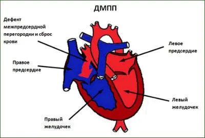 Вродено сърдечно заболяване, причини, лечение, диагностика и класификация