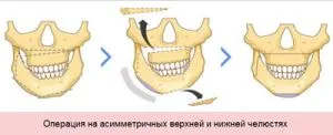 Оперативна корекция на ухапване, когато е необходима операция, реални усложнения