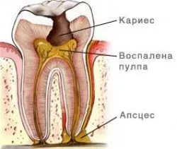 Жените страдат от кариес по-често от мъжете