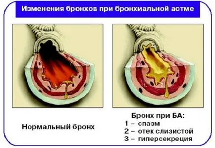 Алергии към домашен прах симптоми, лечение, особено при деца (кърлежи) Алергии към домашен прах симптоми, лечение, особено при деца