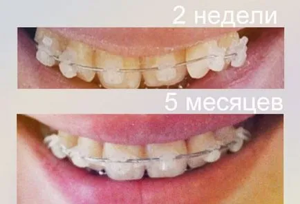 Презрамки различни системи, снимка преди и след инсталацията (скоби снимки преди и след лечението) Презрамки различни системи, снимка преди и след инсталацията
