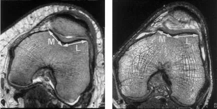 Какво е MRI на колянната става, като процедурата се извършва, както правят снимки