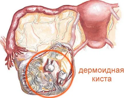 Дермоидните киста на яйчниците причини, симптоми и лечение, последствията от операцията