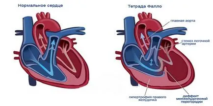 Схематично сърцето ос отклонение, позицията на вертикални и хоризонтални (електрически) Схема сърцето ос отклонение, позицията на вертикални и хоризонтални