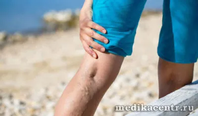 Phlebolith проблем flebolity в урология