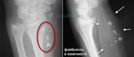 Flebolity в таза и краката причини на лечението, симптоми (таза) Flebolity в таза и краката, причини, лечение, симптомите