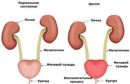 Какво представлява уретрит и нейните симптоми