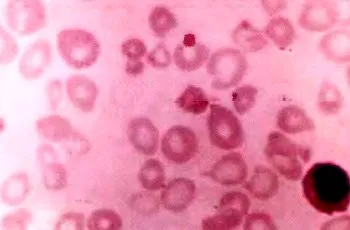 Промяна на размера на червени кръвни клетки microcytosis, макроцитоза, megalotsitoz, shizotsitoz, анизоцитоза