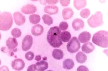 Промяна на размера на червени кръвни клетки microcytosis, макроцитоза, megalotsitoz, shizotsitoz, анизоцитоза