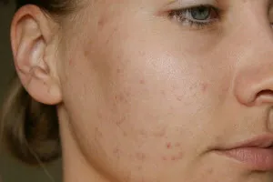 Как да се отървем от следите на пъпки
