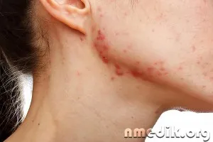 Как да премахнете следите на пъпки и черни точки, след като