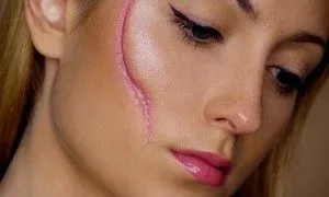 На келоиди белег - това е, как да се чисти, лечение (снимка)