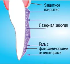 Лазерни избелване на зъбите - цена, реални щети, преди и след снимки