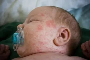 бодлив топлинна обработка при бебета, както и за лечение от бодлив топлина при новороденото