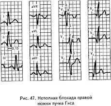 Непълно блокада на CBH на ЕКГ