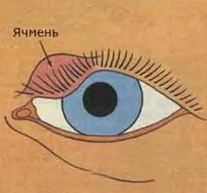 Подуване на горните причини, клепачите на очите, за да направят лечението (причини) Подуване на горните причини, клепачите на очите, които правят, лечение