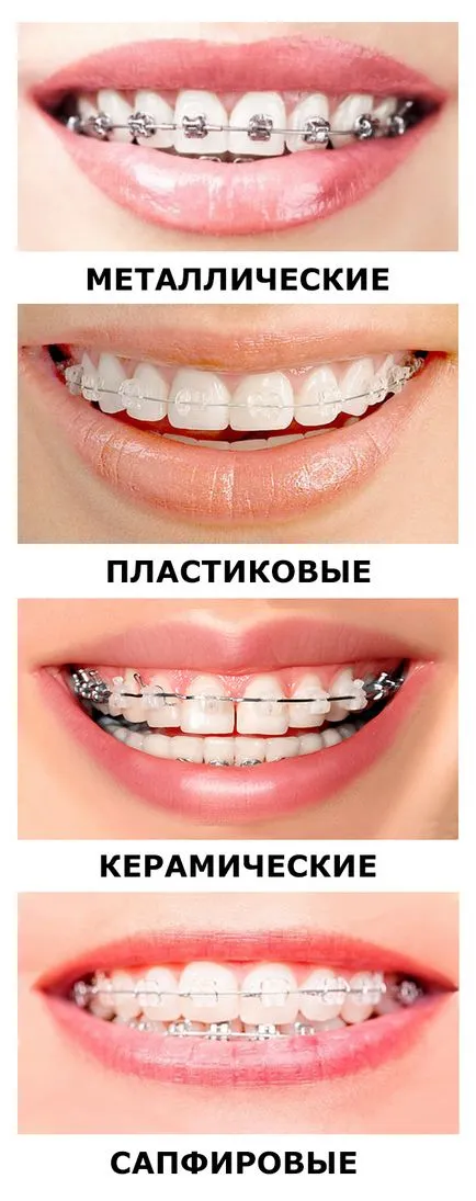 Ортодонтия в стоматологията - защо поставят скоби, защо оправя захапка, защо сложи скоби (здравеопазване) Ортодонтия в стоматологията - защо поставят скоби, защо оправя захапка, защо поставят скоби