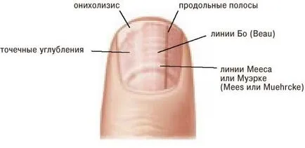 Защо ноктите далеч от кожата причините и лечение на ноктите (защо) Защо ноктите далеч от кожата причините и лечение на ноктите