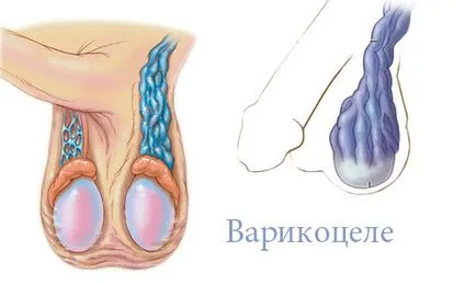 Последици от варикоцеле при мъжете ако не се лекува и да се лекуват