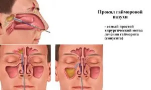 Ако синузит не излиза гной какво да правя, как да се гнойта