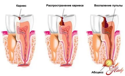 Възможно ли е да се отървем от кариес у дома, без лекари