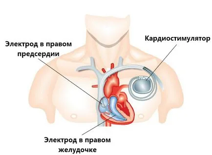 От причинява повишаване на сърдечната честота