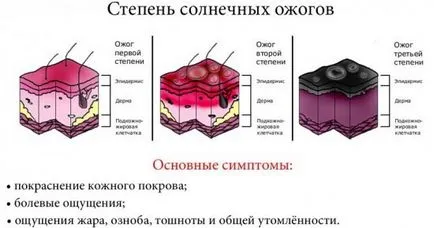 Слънчево изгаряне лечение и оказване на първа помощ за изгаряния на слънце, както и от слънчево изгаряне за лечение (лечение) Слънчево изгаряне лечение и оказване на първа помощ за изгаряния на слънце, както и за лечение на изгаряния от