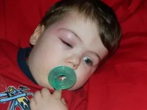 Окото е бил ухапан от комари - подуване и подути очи, отколкото да се премахне и какво да направите, ако ухапан от дете (подуване) Окото е бил ухапан от комари - подуване и подути очи, отколкото да се премахне и какво да направите, ако ухапан от дете
