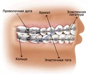На каква възраст сложи шини деца как и кога да се сложи детето си, колко е