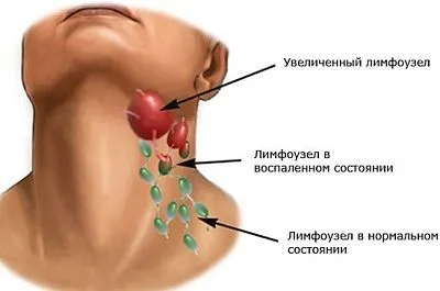Възпалени лимфни възли отколкото лечение