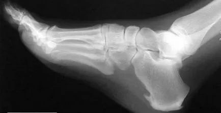 Конспирации и молитви от стимул на петата (calcaneal) Конспирации и молитви от петата шпорите