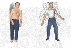 Какво е церебрална атаксия