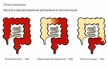 лечение заболяване на червата