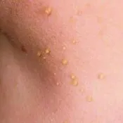 Брадавици по ИТ устните