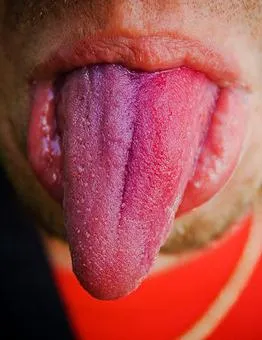 Защо не мога да ям кисело