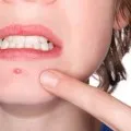 Flux Лечение на венците