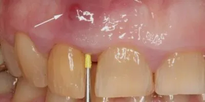 Flux Лечение на венците