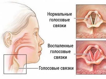 Какво и как да се отнасяме лаещо кашлица Какво и как да се отнасяме лаещо кашлица