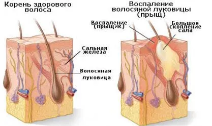 Как да се лекува акне
