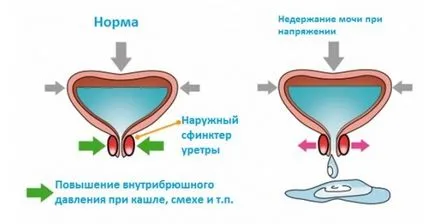 Лечение на уринарна инконтиненция при мъжете