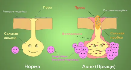 Как да се лекува акне
