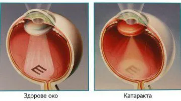 Що за катаракта болестни