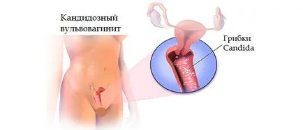 Вулвовагинални го кандидоза Вулвовагинални го кандидоза