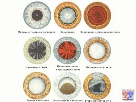 Що за катаракта болестни