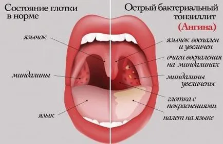 гърлото на детето да се направи червено