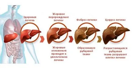Как за лечение на черния дроб, след употреба на алкохол