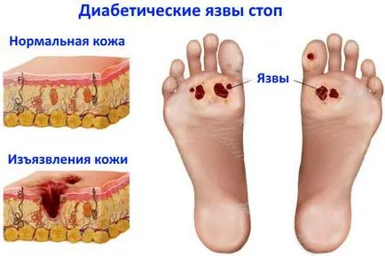 Диабетна Грижа за краката