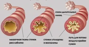 Какво е запушване на бронхите